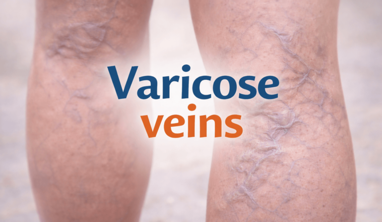 Varicose Veins: Causes, Symptoms, and Practical Ways to Manage Them